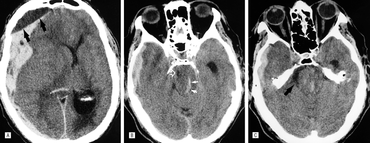 Uncal herniation