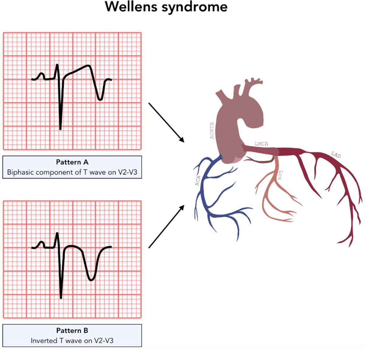 Wellens diagram