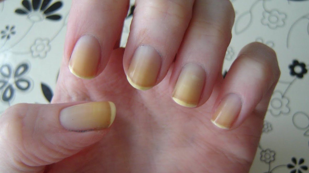 Yellow Nail Syndrome